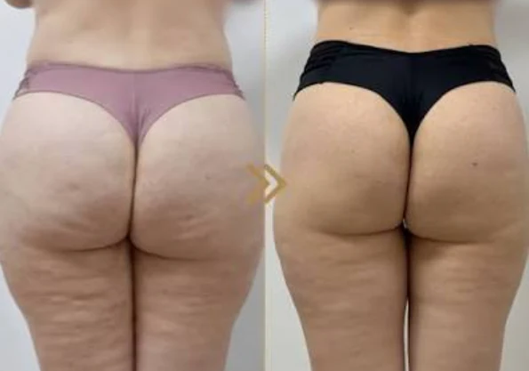 Antes e depois: celulite no bumbum e nas coxas