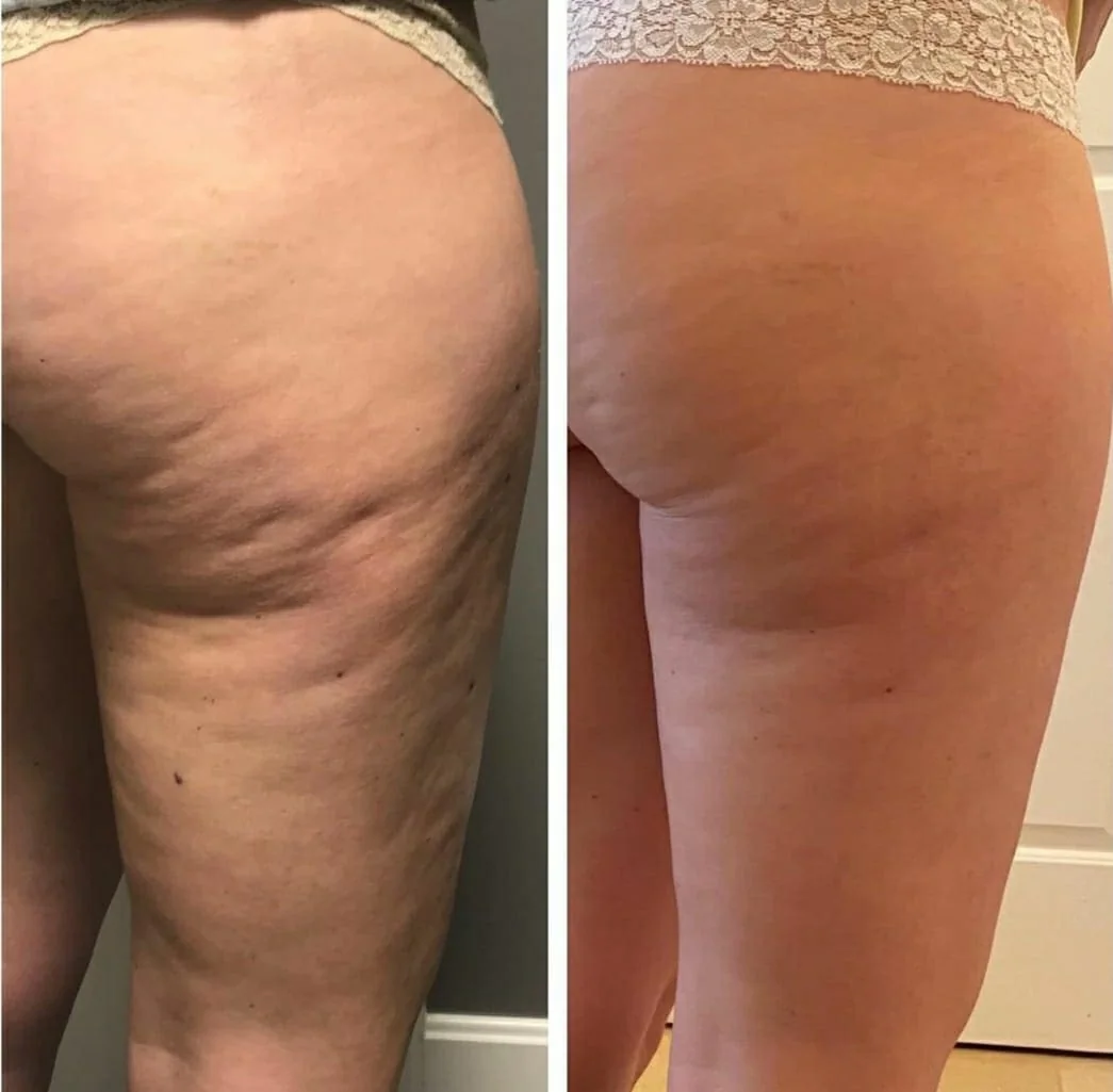 Antes e depois: celulite nas pernas