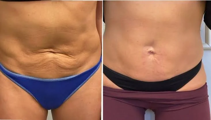 Antes e depois: flacidez na barriga
