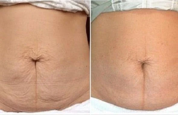 Antes e depois: flacidez na barriga