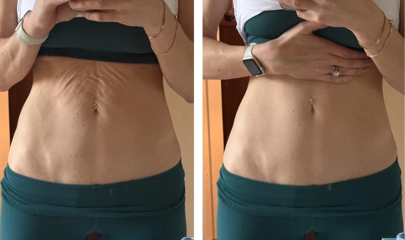 Antes e depois: flacidez na barriga