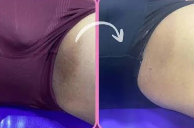 Antes e depois: manchas escuras na região da virilha